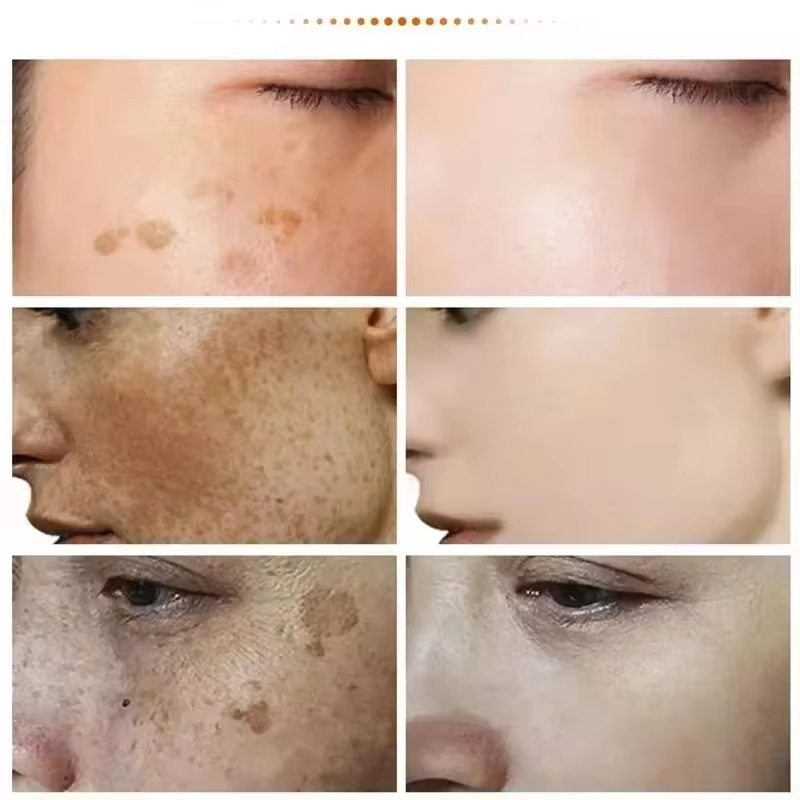 ครีมกำจัดจุดด่างดำที่มีประสิทธ - Luxury Skincare Brands บทวิจารณ์และราคา